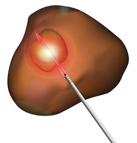 Illustration of a probe targeting a single tumour within the prostate